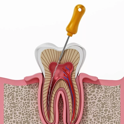 Painless root canal treatment procedure for infected tooth restoration